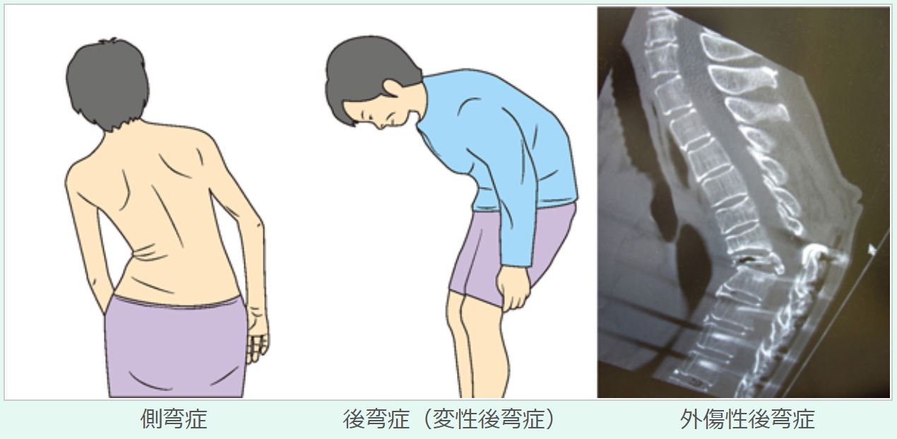 膝の神経の圧迫を防ぐにはどうすればよいでしょうか?