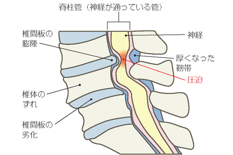 腰部脊柱管狭窄症