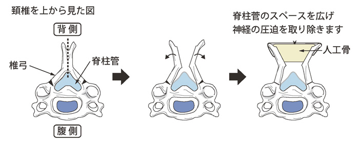 椎弓形成術