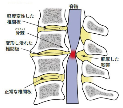 頚椎症性脊髄症