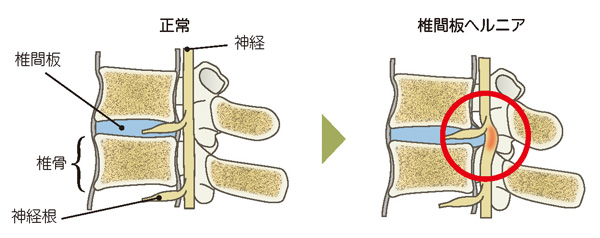 椎間板ヘルニア