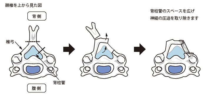 椎弓形成術
