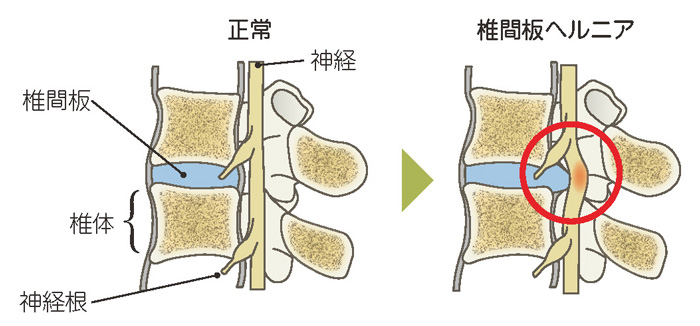 腰椎椎間板ヘルニア