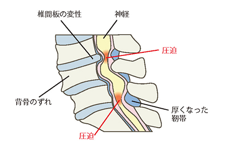 腰部脊柱管狭窄症