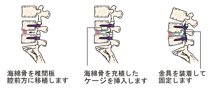 腰椎後方椎体間固定術