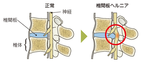 頚椎椎間板ヘルニア