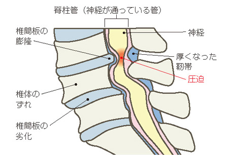 腰部脊柱管狭窄症