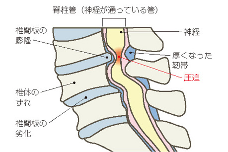 腰部脊柱管狭窄症