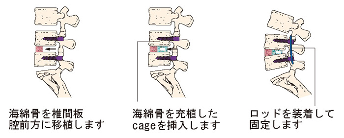 腰椎後方椎体間固定術