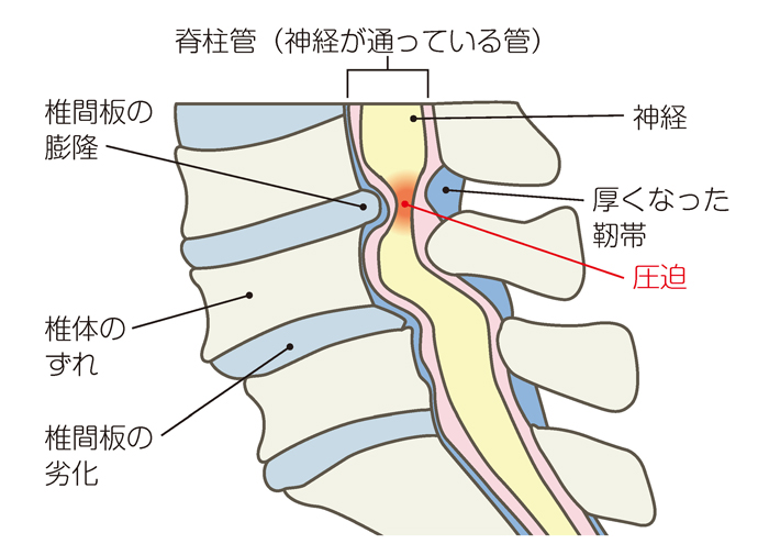 腰部脊柱管狭窄症