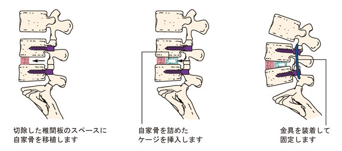 腰椎後方椎体間固定術