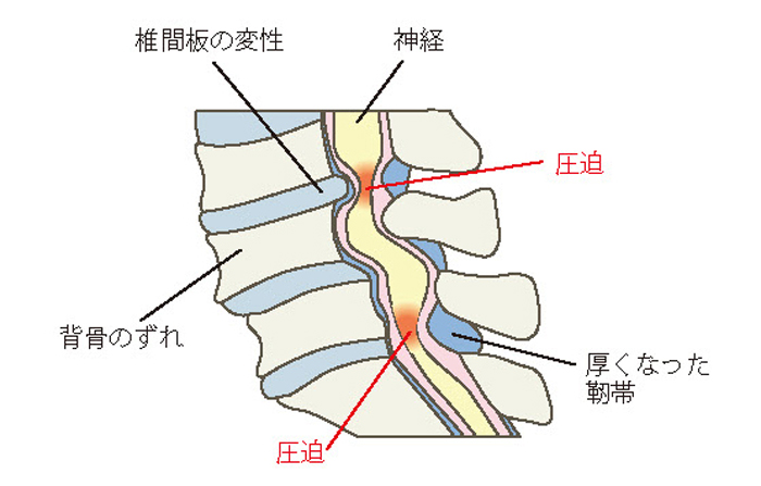 腰部脊柱管狭窄症