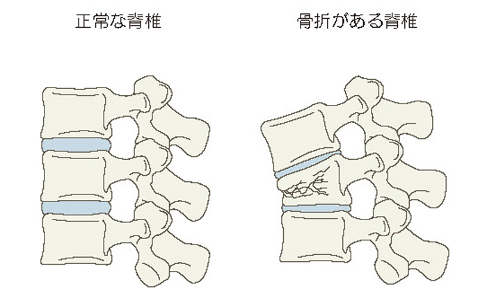 骨粗鬆症性椎体骨折