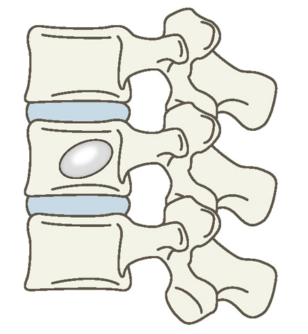 経皮的椎体形成術のイメージ