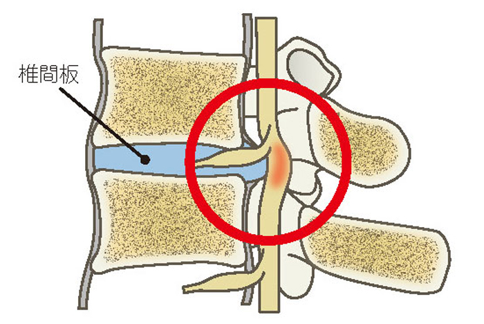 椎間板ヘルニア