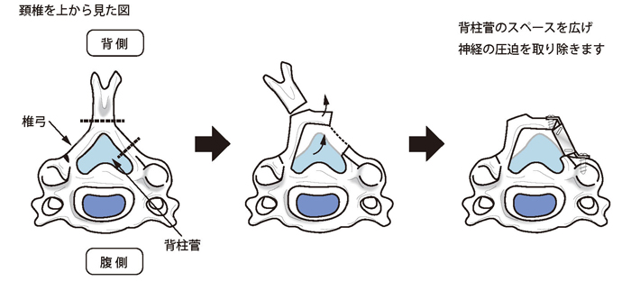 椎弓形成術