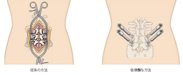 従来の方法と低侵襲な方法
