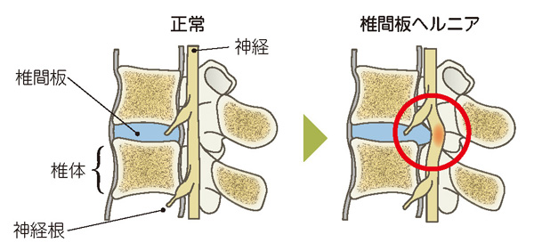 腰椎椎間板ヘルニア