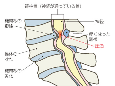 腰部脊柱管狭窄症