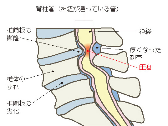 腰部脊柱管狭窄症