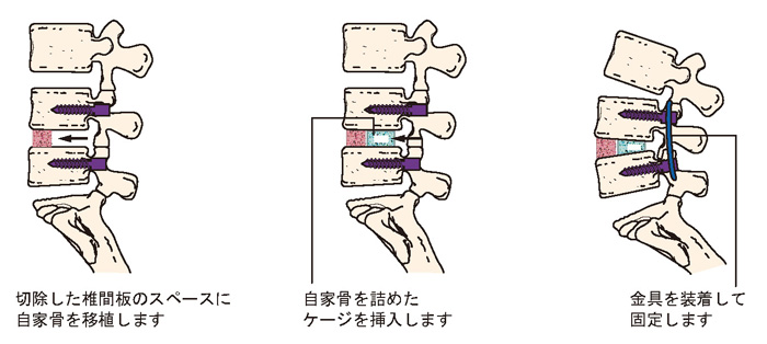 腰椎後方椎体間固定術