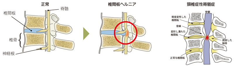 「頸椎椎間板ヘルニア」と「頸椎症性脊髄症」