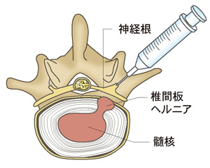 神経根ブロック注射