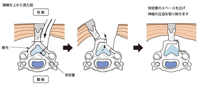 椎弓形成術