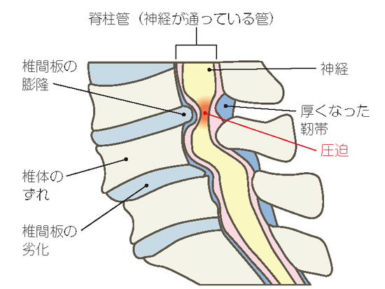 腰部脊柱管狭窄症