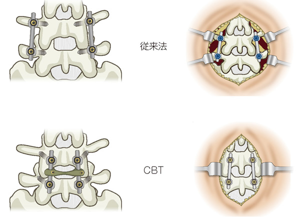 CBT(Cortical Bone Trajectory:皮質骨軌道)スクリュー法