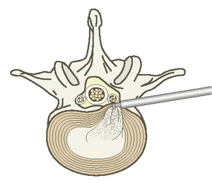 FED(Fullendoscopic Lumbar Discectomy:全内視鏡下腰椎椎間板ヘルニア摘出術)