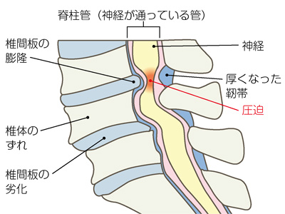 腰部脊柱管狭窄症