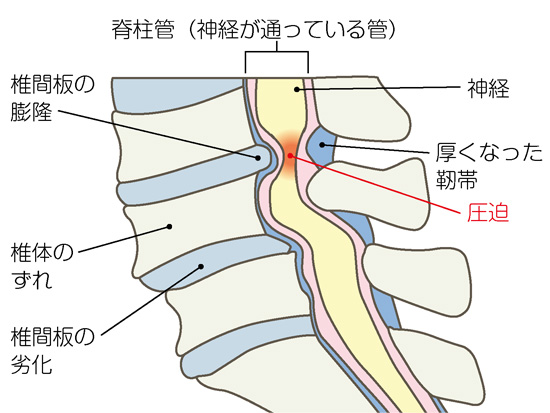 腰部脊柱管狭窄症