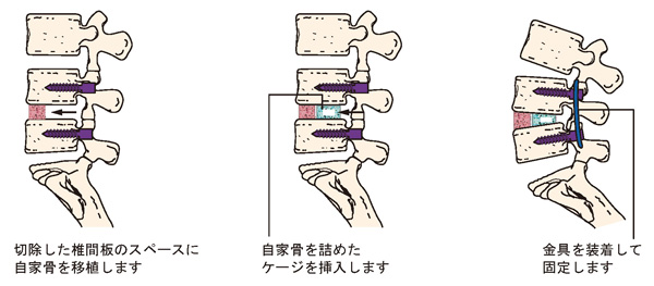 腰椎後方椎体間固定術