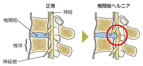 腰椎椎間板ヘルニア