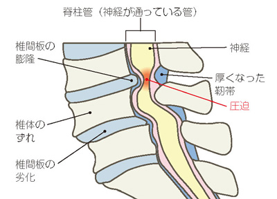 腰部脊柱管狭窄症