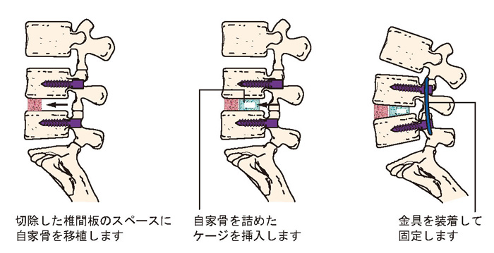 腰椎後方椎体間固定術