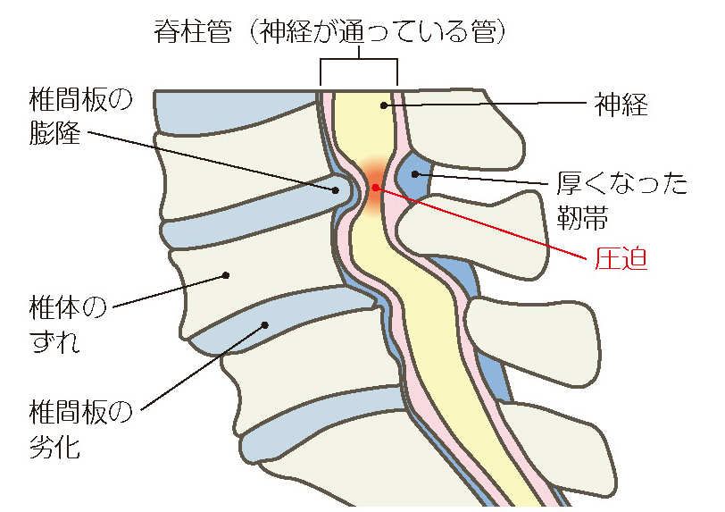 腰部脊柱管狭窄症