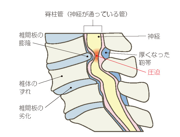 腰部脊柱管狭窄症