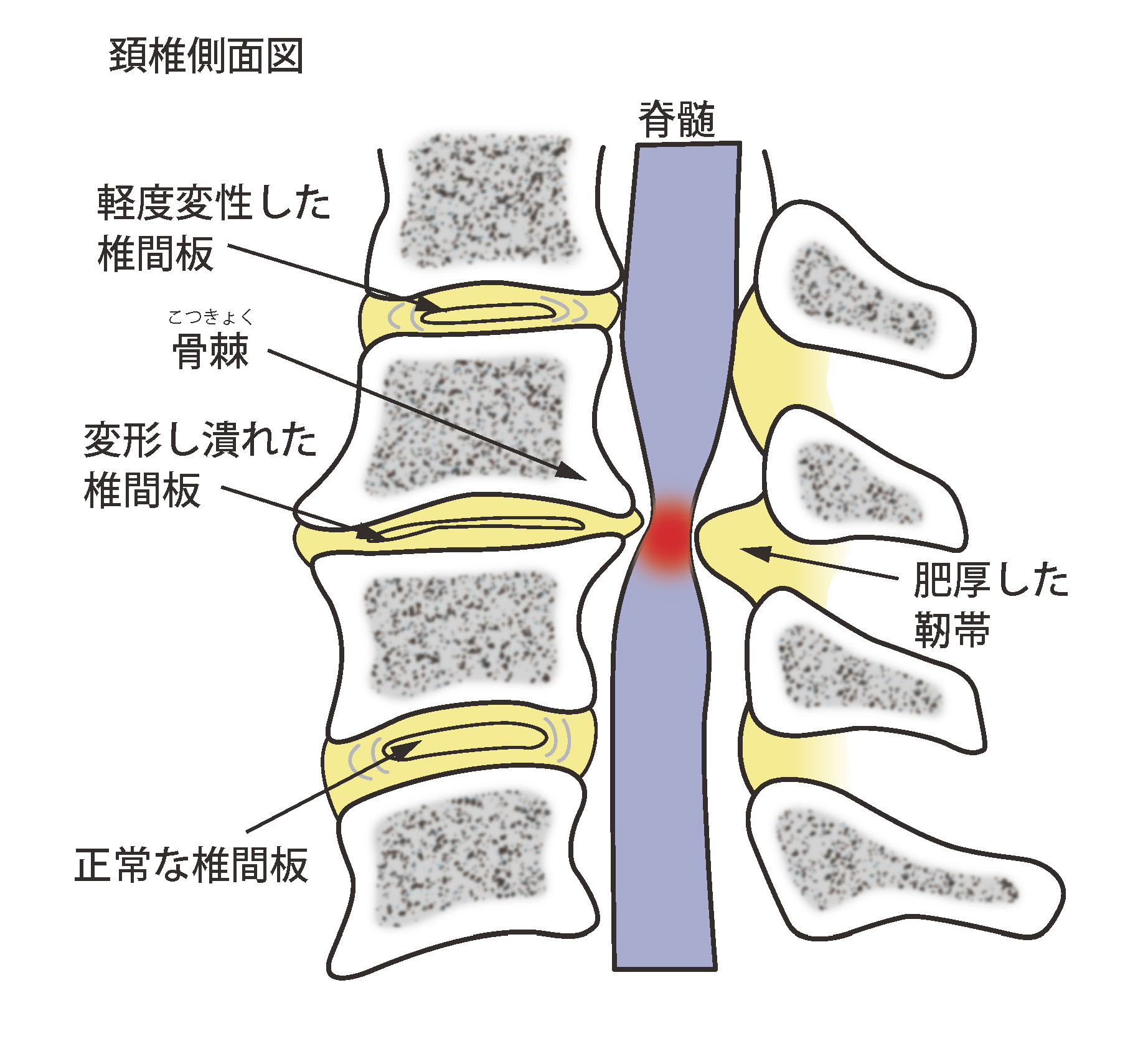 頚椎症性神経根症