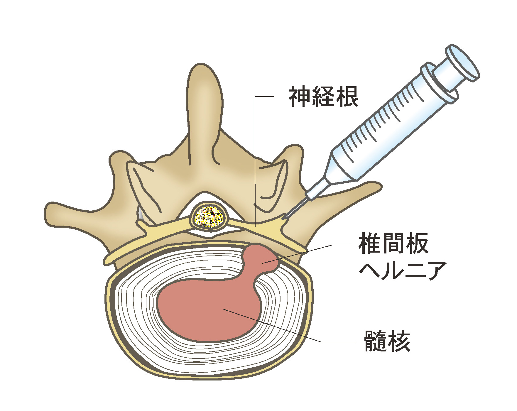 神経根ブロック注射