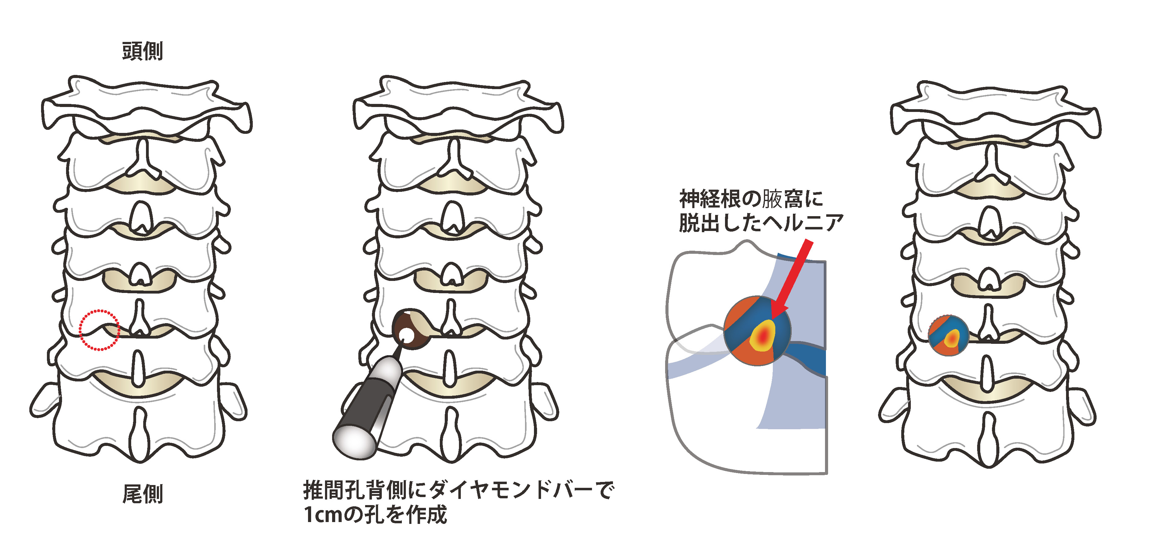 椎間孔拡大術